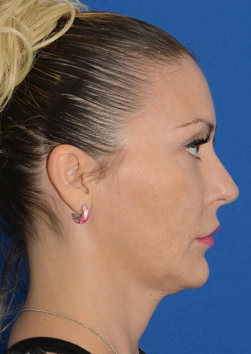 Facelift Before & After Gallery - Patient 140133 - Image 7