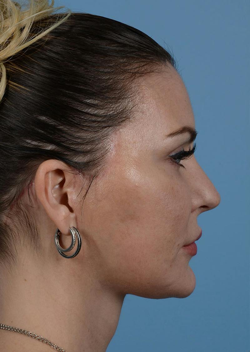 Facelift Before & After Gallery - Patient 140133 - Image 8