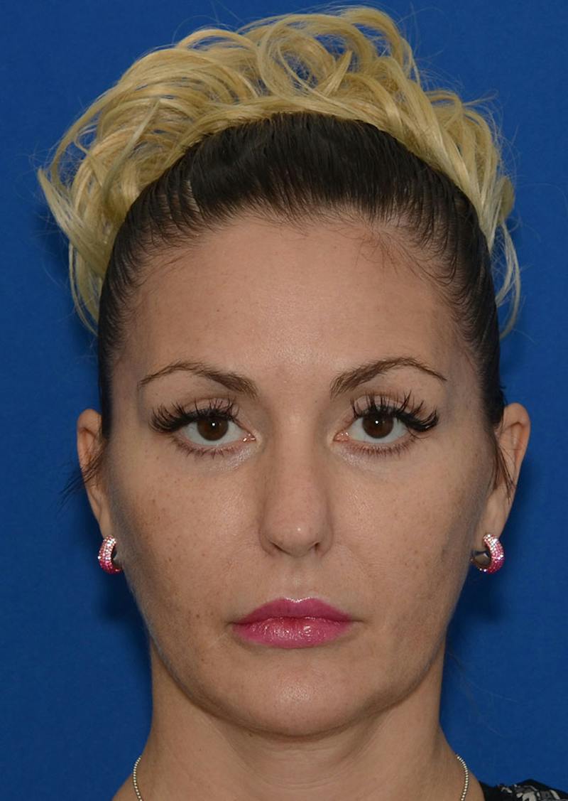 Facelift Before & After Gallery - Patient 140133 - Image 9