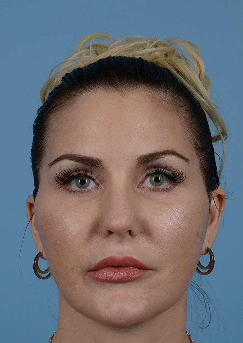 Facelift Before & After Gallery - Patient 140133 - Image 10