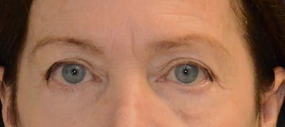 Blepharoplasty Before & After Gallery - Patient 720800 - Image 1