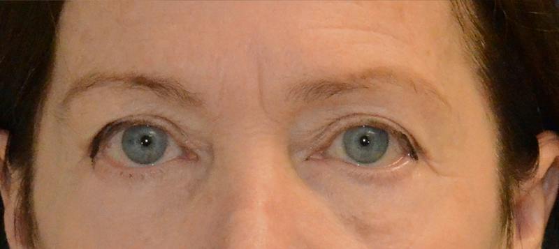 Blepharoplasty Before & After Gallery - Patient 720800 - Image 1