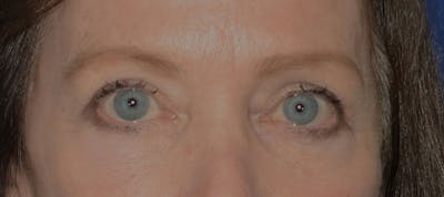 Blepharoplasty Before & After Gallery - Patient 720800 - Image 2