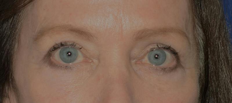 Blepharoplasty Before & After Gallery - Patient 720800 - Image 2