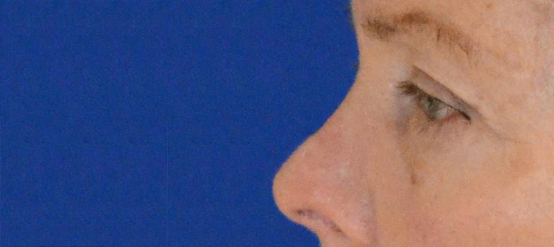 Blepharoplasty Before & After Gallery - Patient 720800 - Image 3