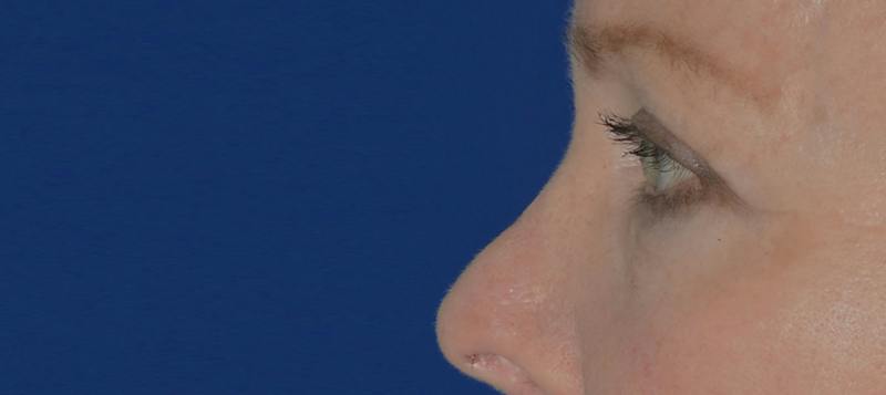 Blepharoplasty Before & After Gallery - Patient 720800 - Image 4