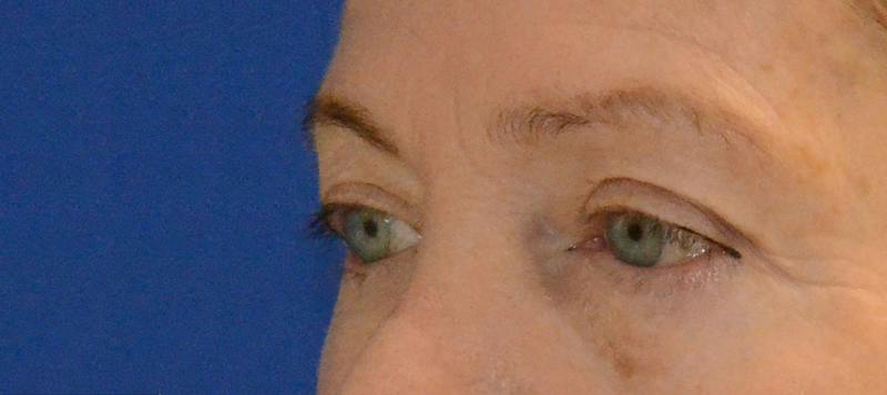 Blepharoplasty Before & After Gallery - Patient 720800 - Image 5