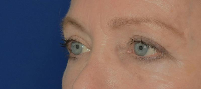 Blepharoplasty Before & After Gallery - Patient 720800 - Image 6