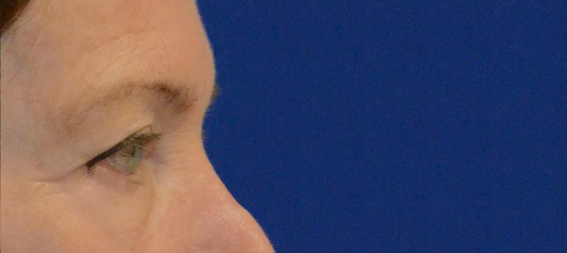 Blepharoplasty Before & After Gallery - Patient 720800 - Image 7