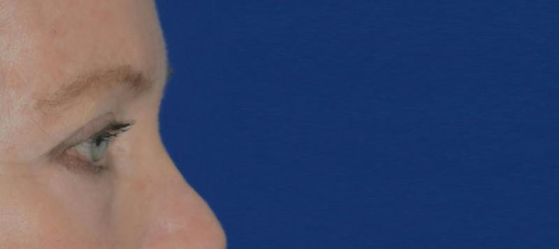 Blepharoplasty Before & After Gallery - Patient 720800 - Image 8