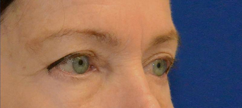 Blepharoplasty Before & After Gallery - Patient 720800 - Image 9