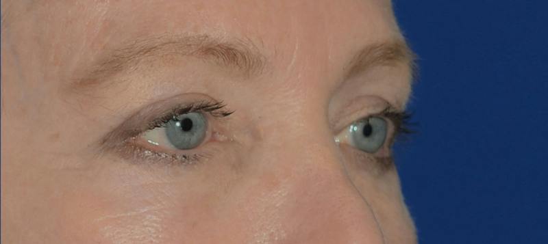 Blepharoplasty Before & After Gallery - Patient 720800 - Image 10