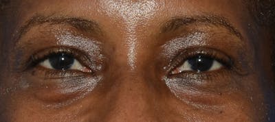 Blepharoplasty Before & After Gallery - Patient 226396 - Image 1