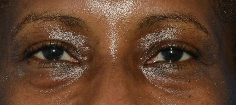 Blepharoplasty Before & After Gallery - Patient 226396 - Image 1