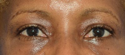Blepharoplasty Before & After Gallery - Patient 226396 - Image 2