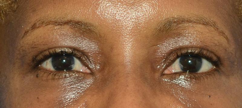 Blepharoplasty Before & After Gallery - Patient 226396 - Image 2
