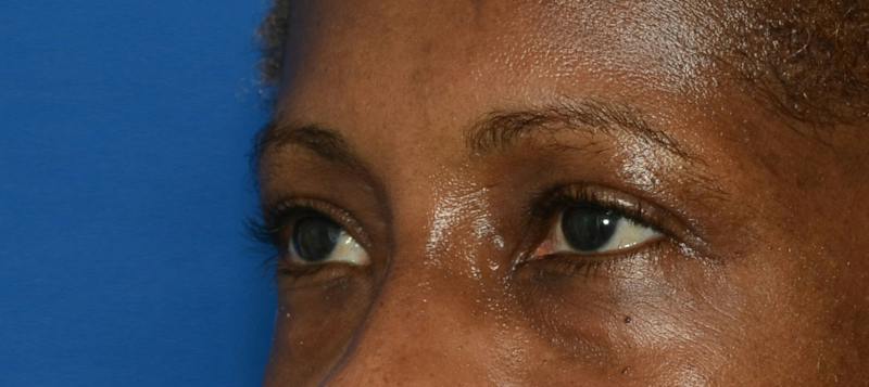 Blepharoplasty Before & After Gallery - Patient 226396 - Image 5
