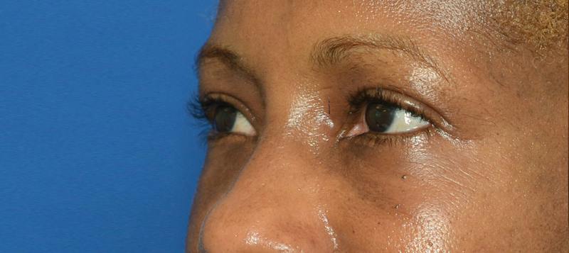 Blepharoplasty Before & After Gallery - Patient 226396 - Image 6