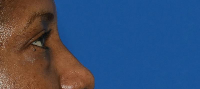 Blepharoplasty Before & After Gallery - Patient 226396 - Image 7