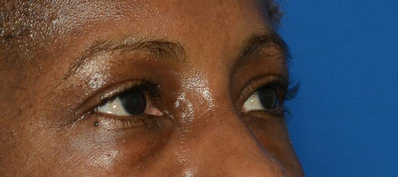 Blepharoplasty Before & After Gallery - Patient 226396 - Image 9