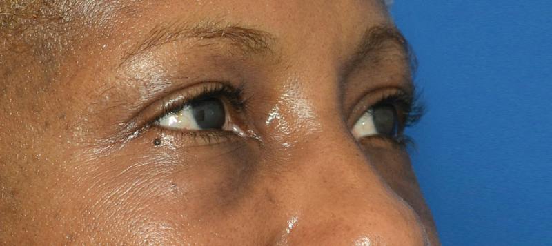 Blepharoplasty Before & After Gallery - Patient 226396 - Image 10