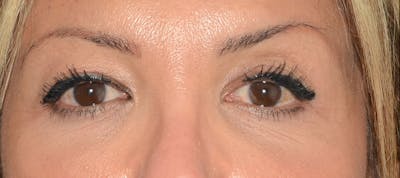 Blepharoplasty Before & After Gallery - Patient 351633 - Image 1