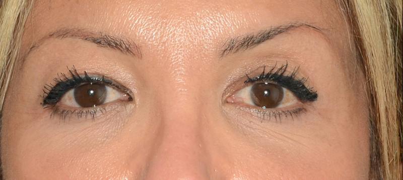 Blepharoplasty Before & After Gallery - Patient 351633 - Image 1