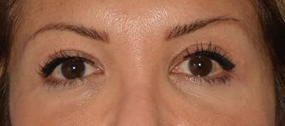Blepharoplasty Before & After Gallery - Patient 351633 - Image 2
