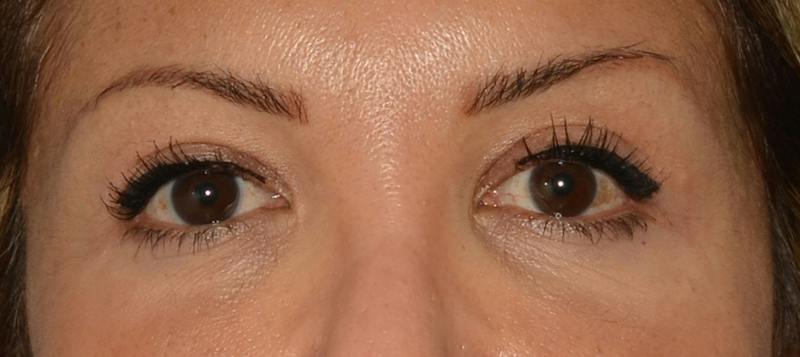 Blepharoplasty Before & After Gallery - Patient 351633 - Image 2