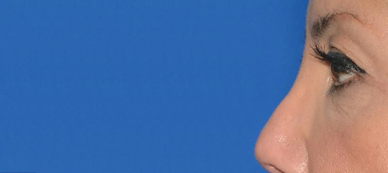 Blepharoplasty Before & After Gallery - Patient 351633 - Image 3