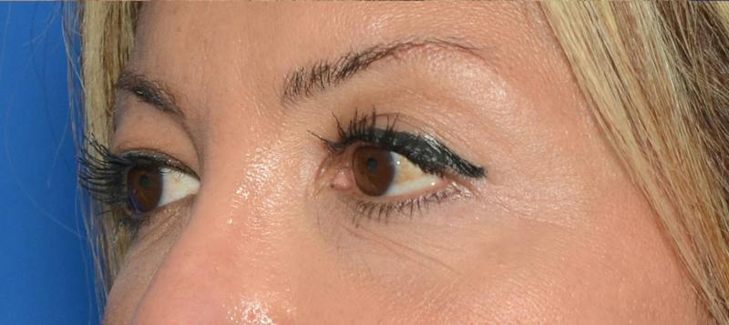 Blepharoplasty Before & After Gallery - Patient 351633 - Image 5