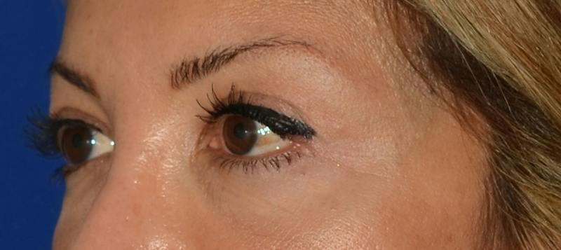 Blepharoplasty Before & After Gallery - Patient 351633 - Image 6