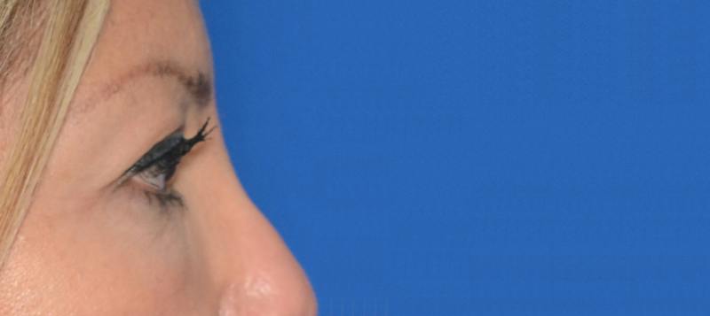 Blepharoplasty Before & After Gallery - Patient 351633 - Image 7