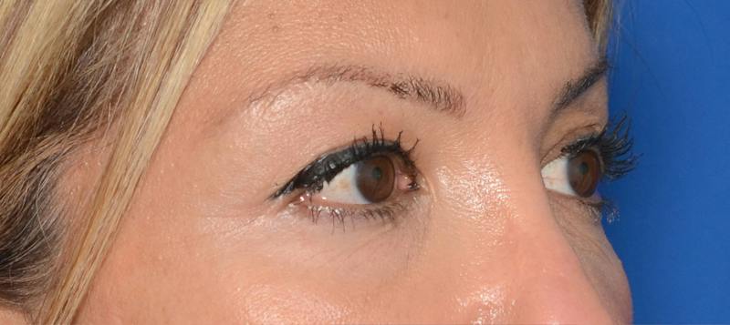 Blepharoplasty Before & After Gallery - Patient 351633 - Image 9