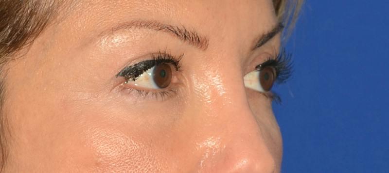 Blepharoplasty Before & After Gallery - Patient 351633 - Image 10