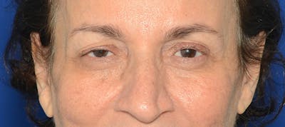 Blepharoplasty Before & After Gallery - Patient 253004 - Image 1