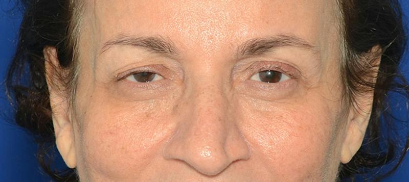 Blepharoplasty Before & After Gallery - Patient 253004 - Image 1