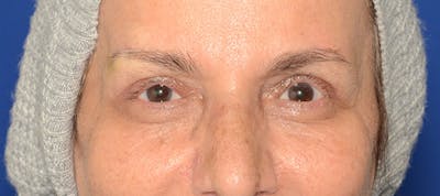 Blepharoplasty Before & After Gallery - Patient 253004 - Image 2