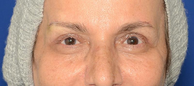 Blepharoplasty Before & After Gallery - Patient 253004 - Image 2