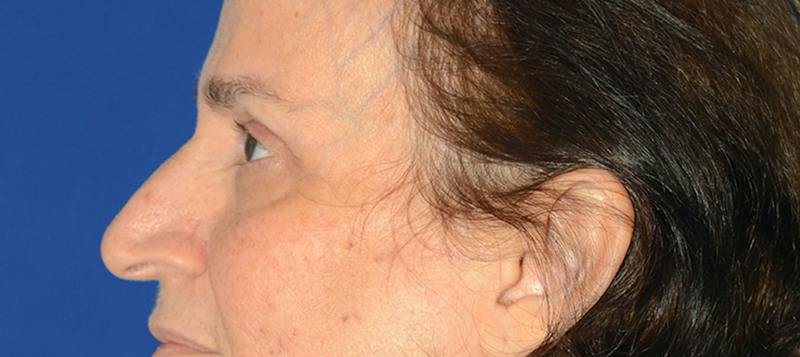 Blepharoplasty Before & After Gallery - Patient 253004 - Image 3