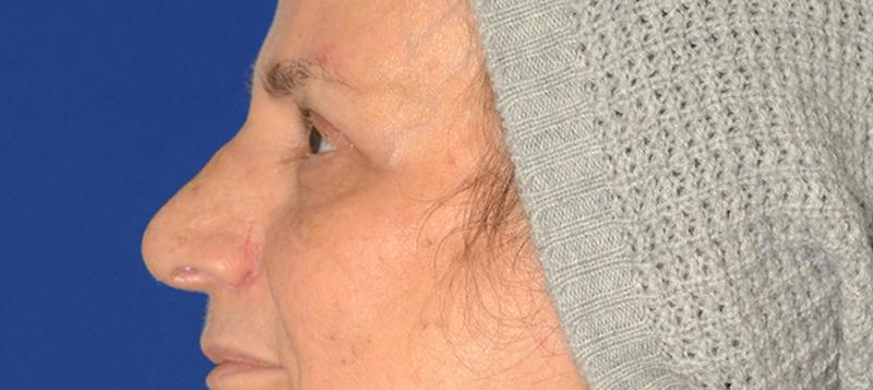 Blepharoplasty Before & After Gallery - Patient 253004 - Image 4