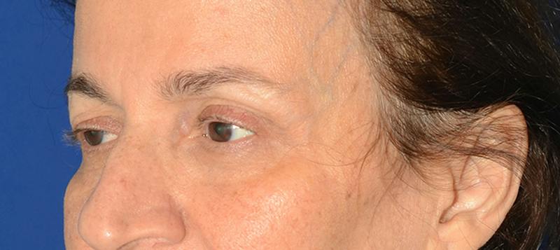 Blepharoplasty Before & After Gallery - Patient 253004 - Image 5