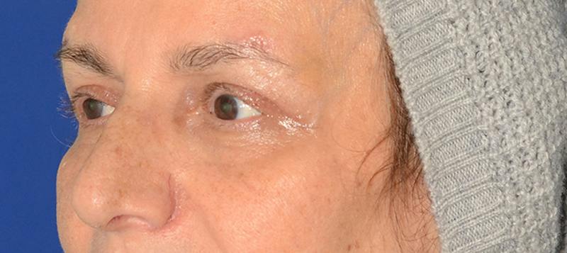 Blepharoplasty Before & After Gallery - Patient 253004 - Image 6