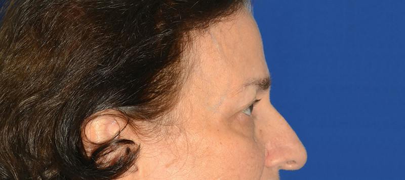 Blepharoplasty Before & After Gallery - Patient 253004 - Image 7