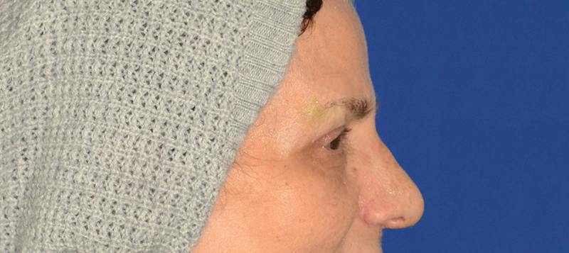 Blepharoplasty Before & After Gallery - Patient 253004 - Image 8
