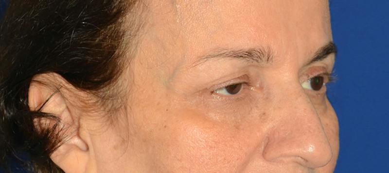 Blepharoplasty Before & After Gallery - Patient 253004 - Image 9