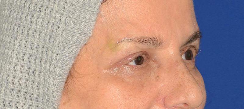 Blepharoplasty Before & After Gallery - Patient 253004 - Image 10