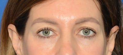 Blepharoplasty Before & After Gallery - Patient 335083 - Image 1