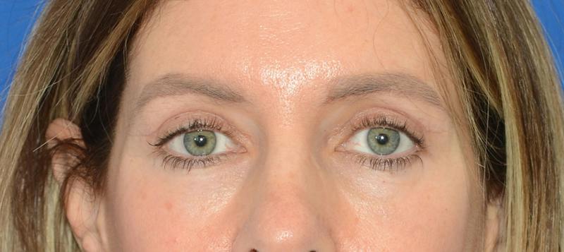 Blepharoplasty Before & After Gallery - Patient 335083 - Image 2