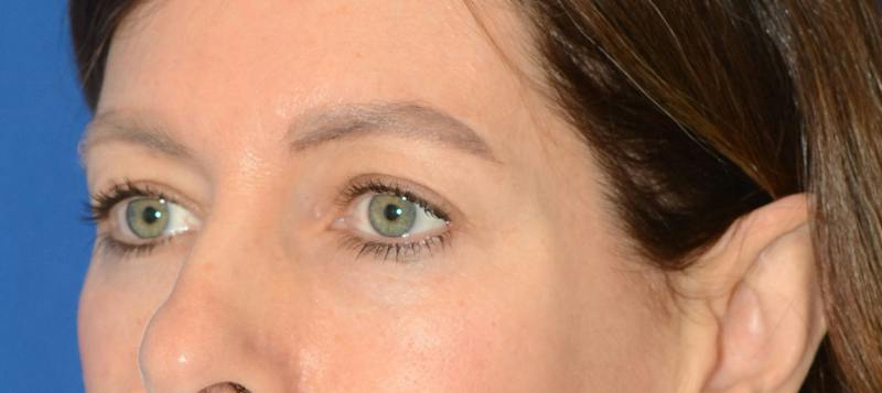 Blepharoplasty Before & After Gallery - Patient 335083 - Image 3